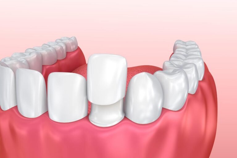 Porcelain Veneers